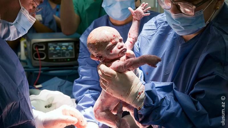 İngiltərədə uşaqlıq transplantasiyası ilə ilk körpə doğulub - Foto