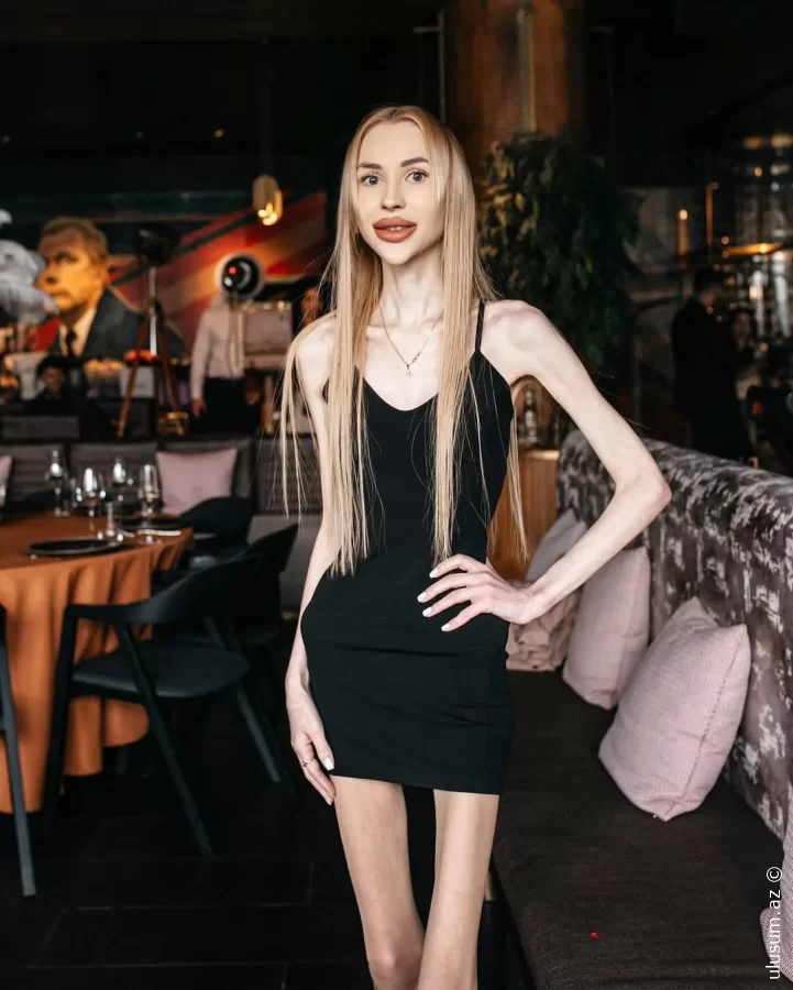 Alina Lipnitskaya "Skeleton Queen" ləqəbli Ukraynanın ən arıq qızı