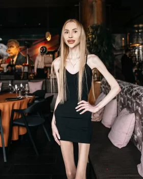 Alina Lipnitskaya  "Skeleton Queen" ləqəbli Ukraynanın ən arıq qızı