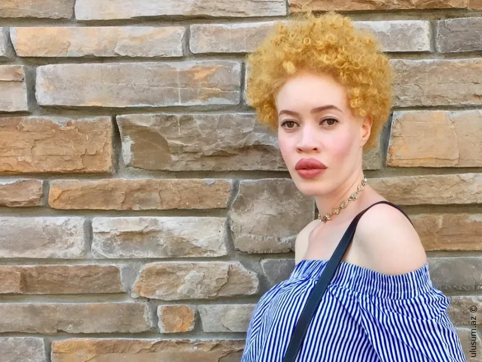 Fərqliliyi ilə dünyanı fəth edən qadın – Diandra Forrestin albinizm hekayəsi - FOTO