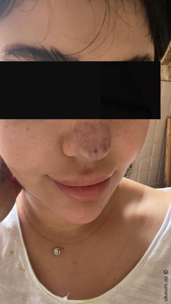 Burun Dolğusu Faciəsi: Klinikanın Fəaliyyəti Dayandırıldı - FOTO
