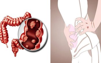 Bağırsaq xərçəngi səssizcə yaxınlaşır – bu əlamətlərə laqeyd qalmayın
