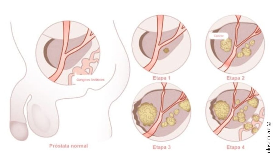 Prostatit nədir?