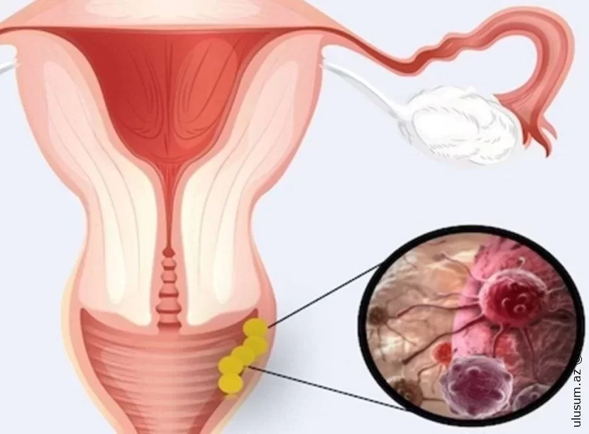 Onkoginekoloq Uşaqlıq və Yumurtalıq Xərçəngindən Xəbərdar Edir     Qadın Sağlamlığı Təhlükədə