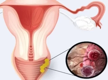 Onkoginekoloq Uşaqlıq və Yumurtalıq Xərçəngindən Xəbərdar Edir     Qadın Sağlamlığı Təhlükədə