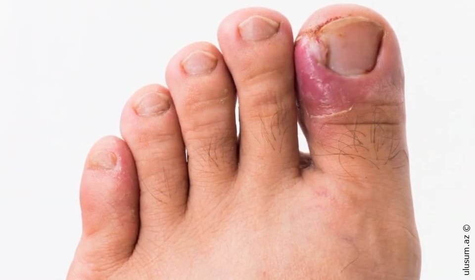 Dırnağın ətə batması — Onikokriptoz