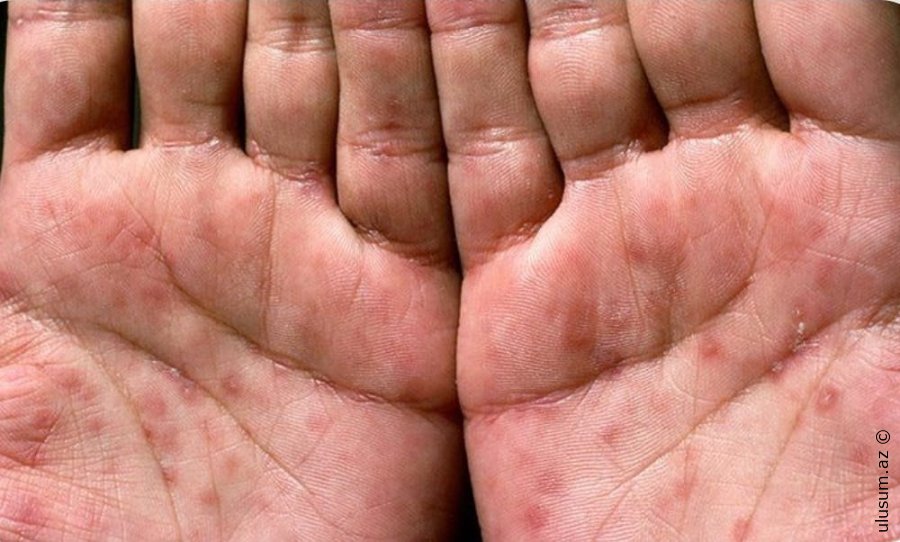 Cinsi Yolla Keçən Təhlükəli İnfeksiyalar