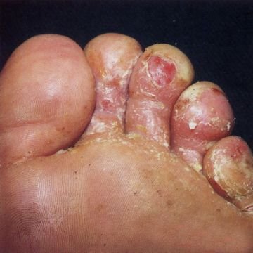 Sirkəli su göbələyi yox edir?