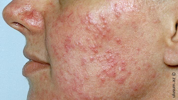 ROZASEA (Qızılgül) Xəstəliyi Nədir?