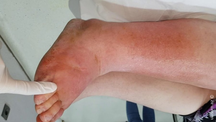 Baldırda Şişkinlik və Qızartı — Qızıl Yelin Əlaməti Ola Bilər!