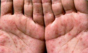 Cinsi Yolla Keçən Təhlükəli İnfeksiyalar