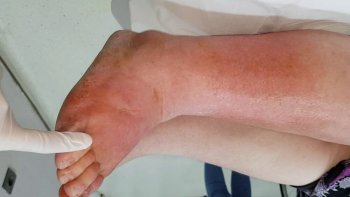 Baldırda Şişkinlik və Qızartı — Qızıl Yelin Əlaməti Ola Bilər!