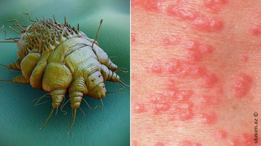 Qotur təhlükəsi: Səpgilər varsa, antibiotik yox – düzgün diaqnoz vacibdir!