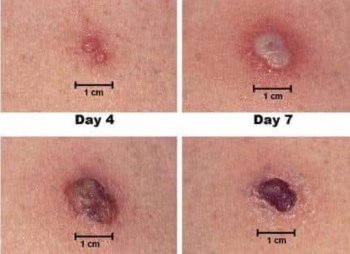 Şarbon təhlükəsi: Bu simptomlara diqqət